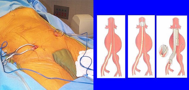 endovasküler-greftleme