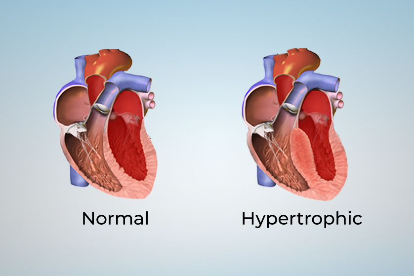 hipertrofik-kardiyomiyopati