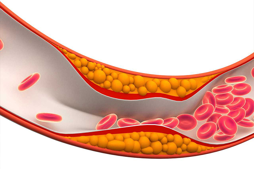 kolesterol-hiperlipidemi