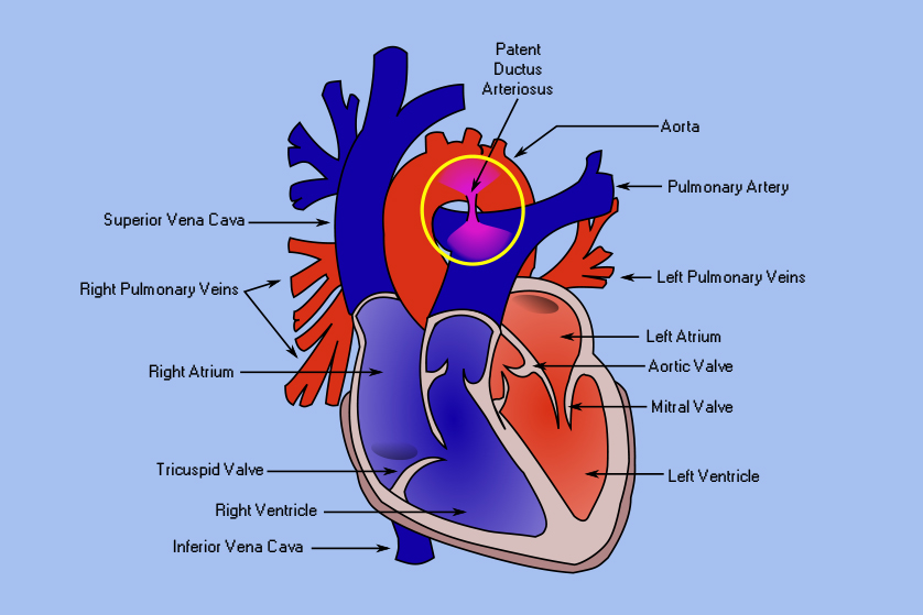 patent-duktus-afteriosus