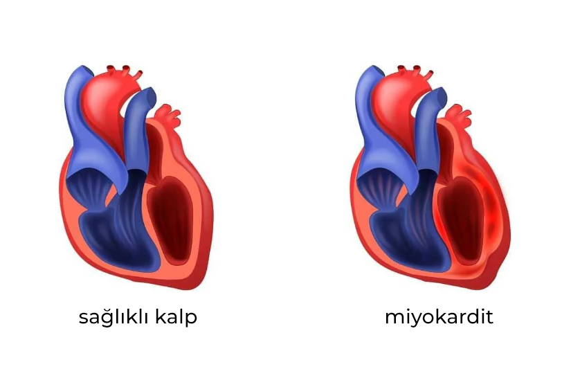 miyokardit