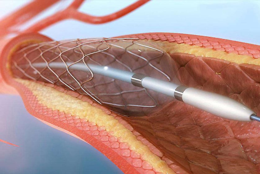 anjioplasti-stent