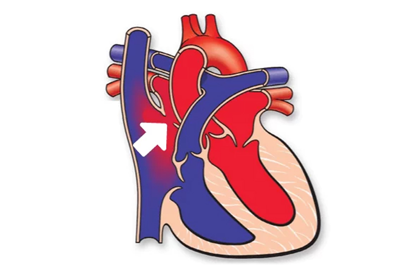 atrial-septal-defekt