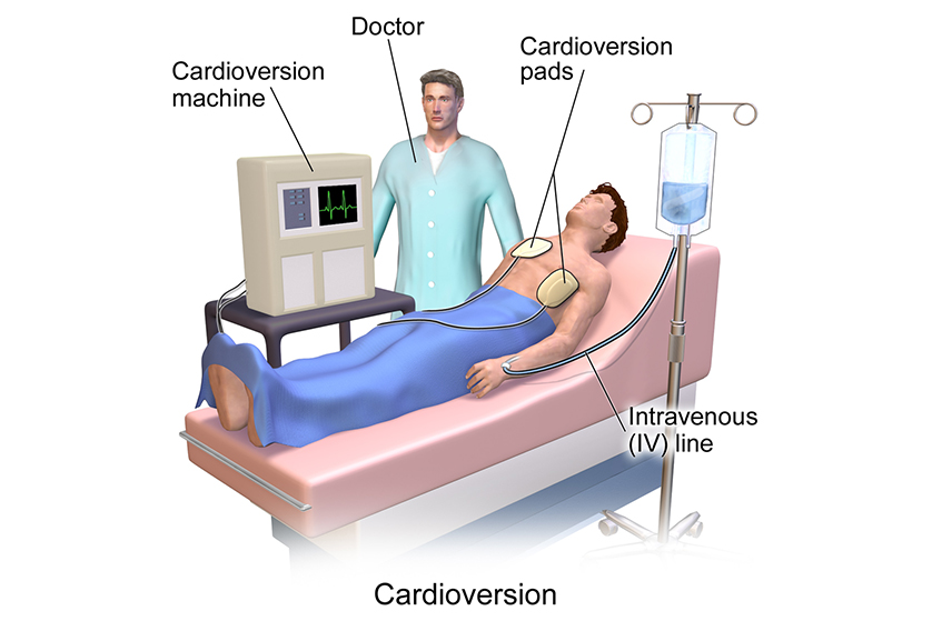 elektriksel-kardiyoversiyon