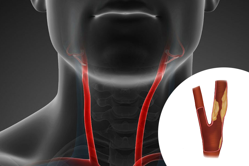 karotid-arter-hastaligi