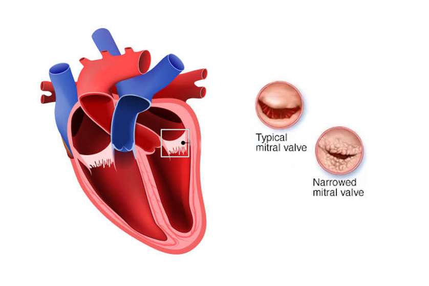 mitral-kapak-darligi