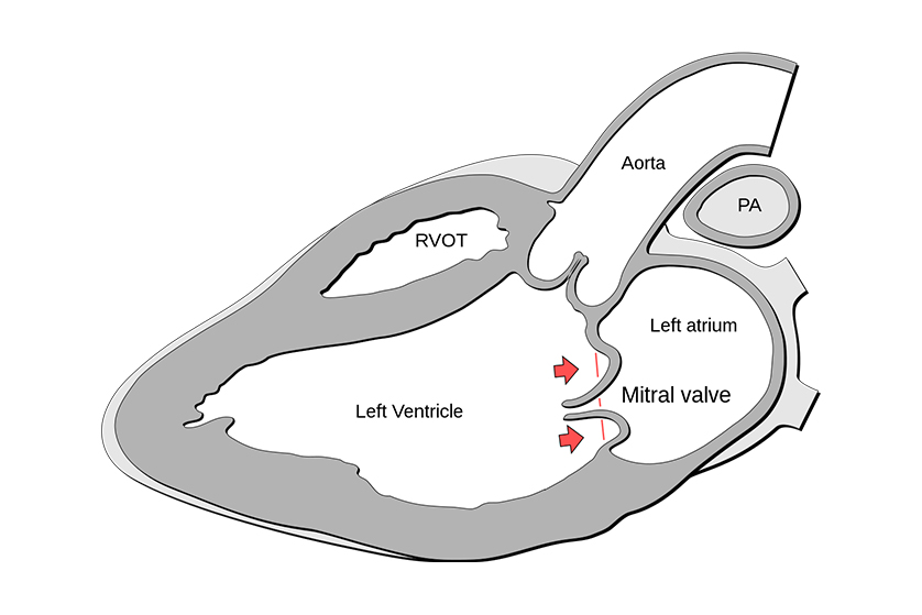 mitral-kapak-prolapsusu