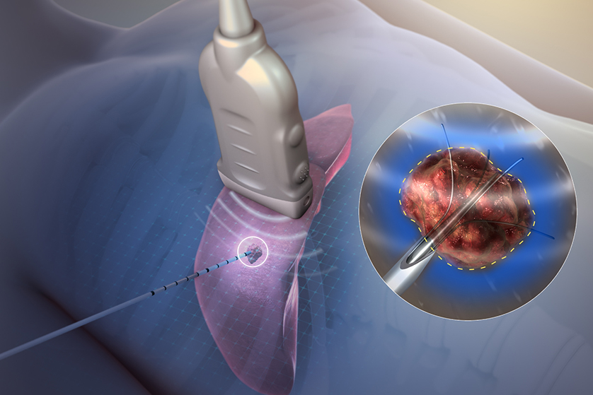 radyofrekans-ablasyon