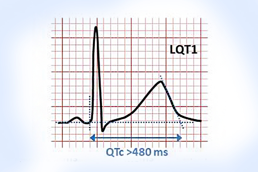 uzun-qt-sendromu