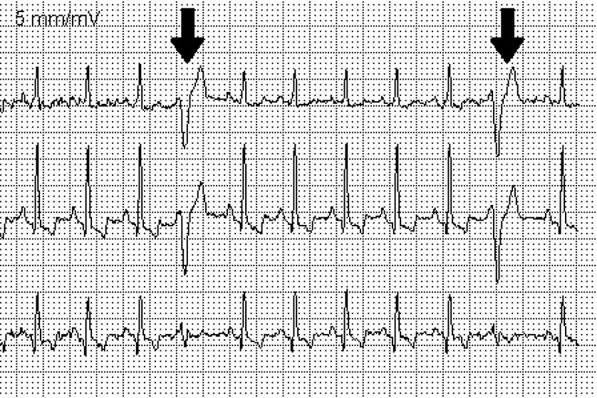 ventrikuler-ekstrasistol