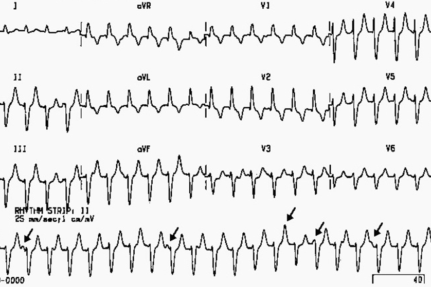 ventrikuler-tasikardi